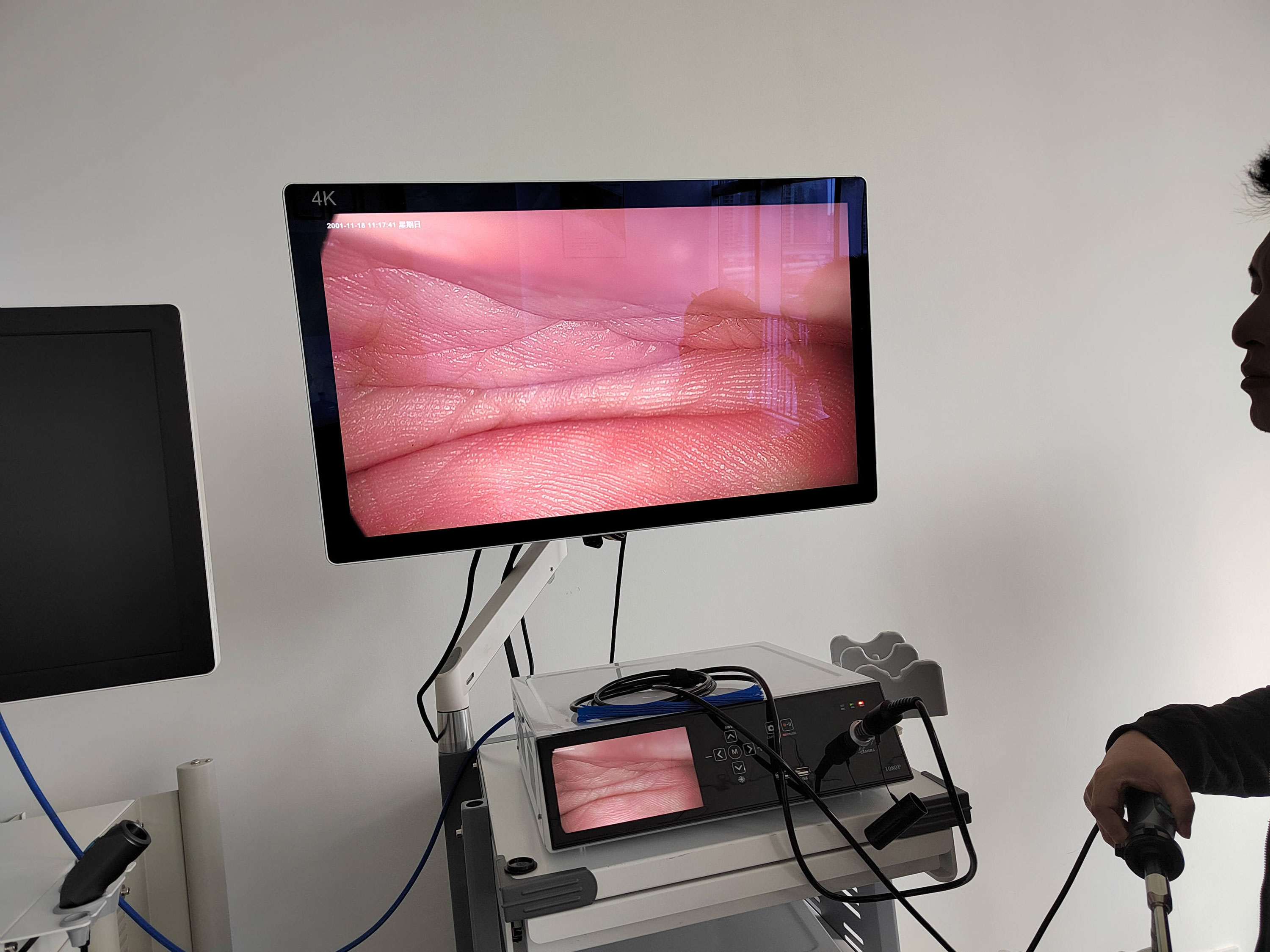 Appareil d'endoscopie médicale Full HD Système d'endoscopie vidéo pour ORL Laparoscope Hystéroscopie